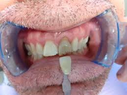blanchiment interne dents
