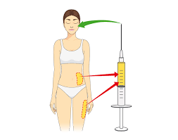 technique lipofilling