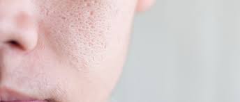 pores dilatés